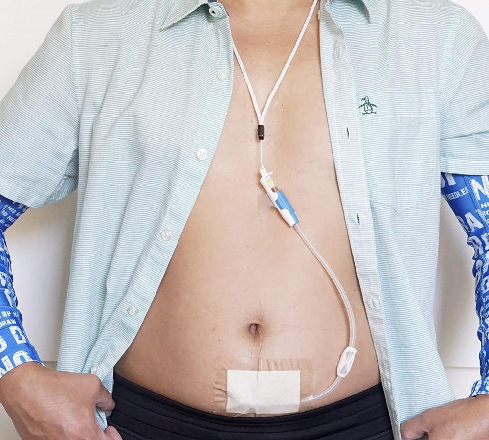 Peritoneal Dialysis - Nursing services in Patna - peritoneal dialysis patna - Nursing Sarathi
